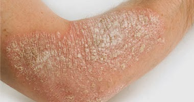 El sodio tiosulfat a atopicheskom la dermatitis